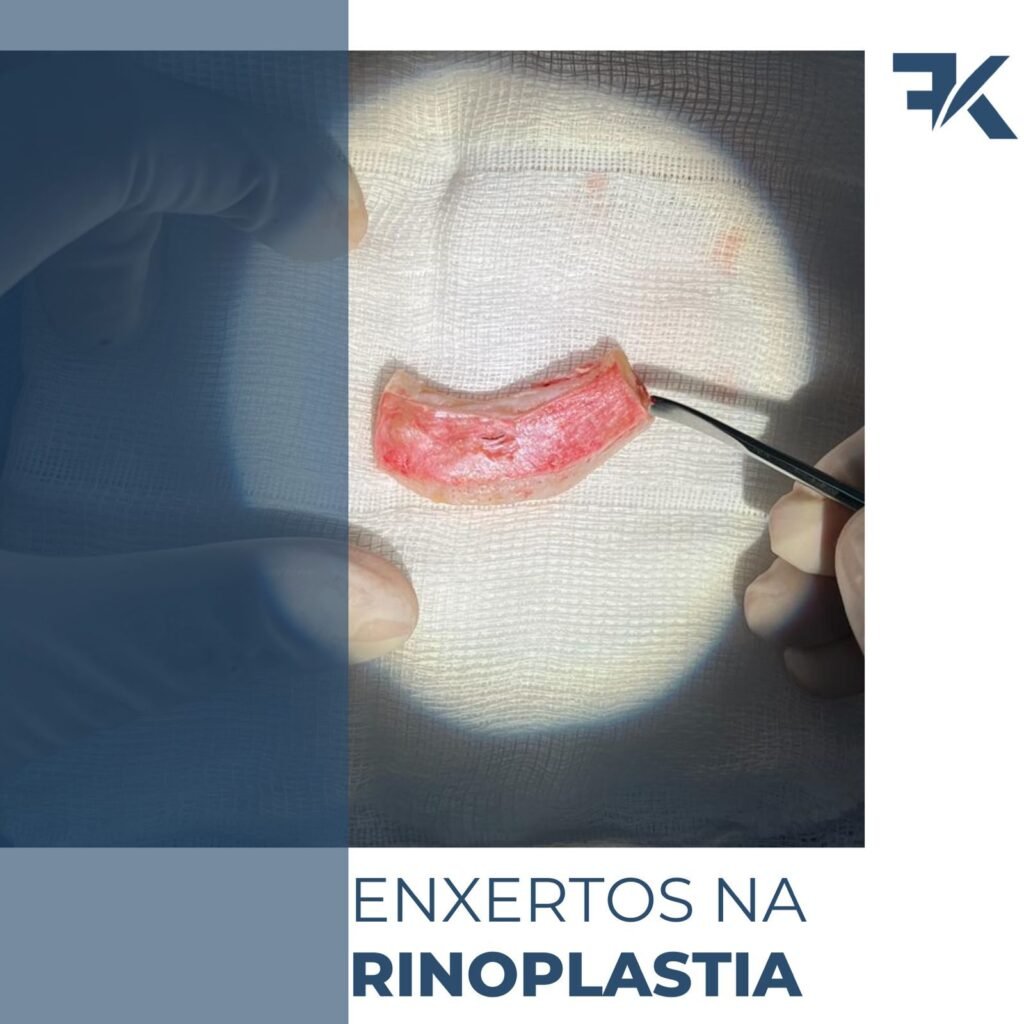 Enxertos na Rinoplastia