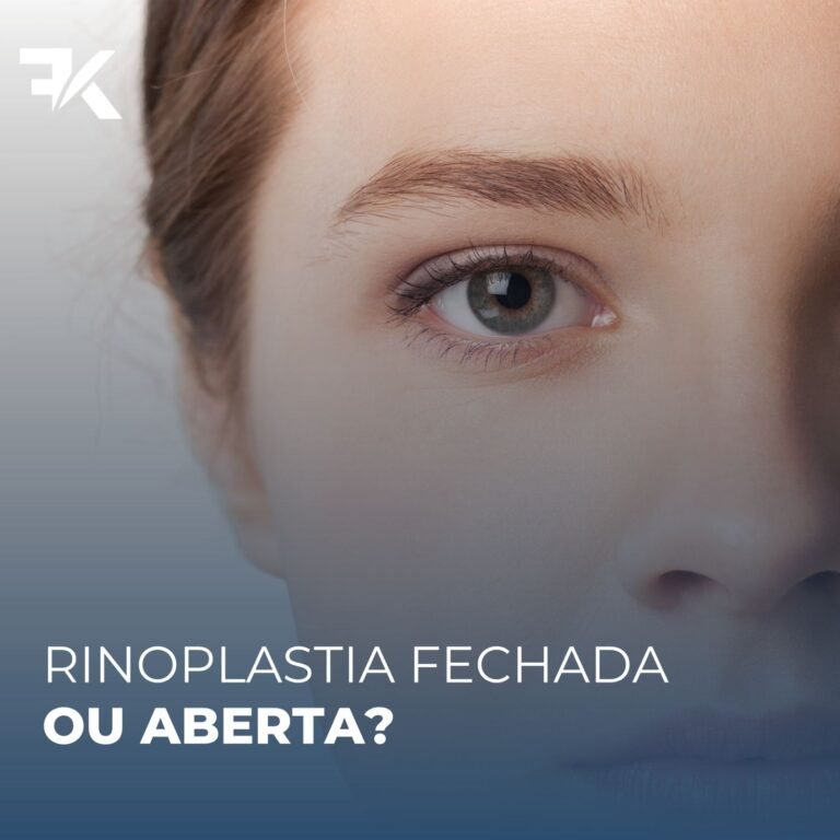 Rinoplastia fechada ou aberta?