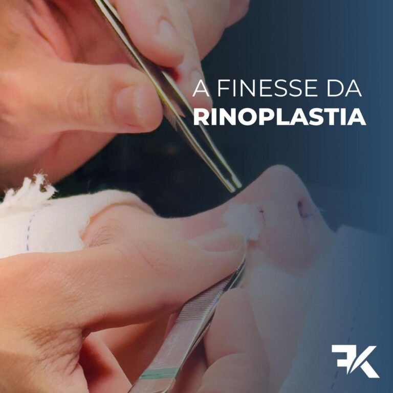 A finesse da Rinoplastia